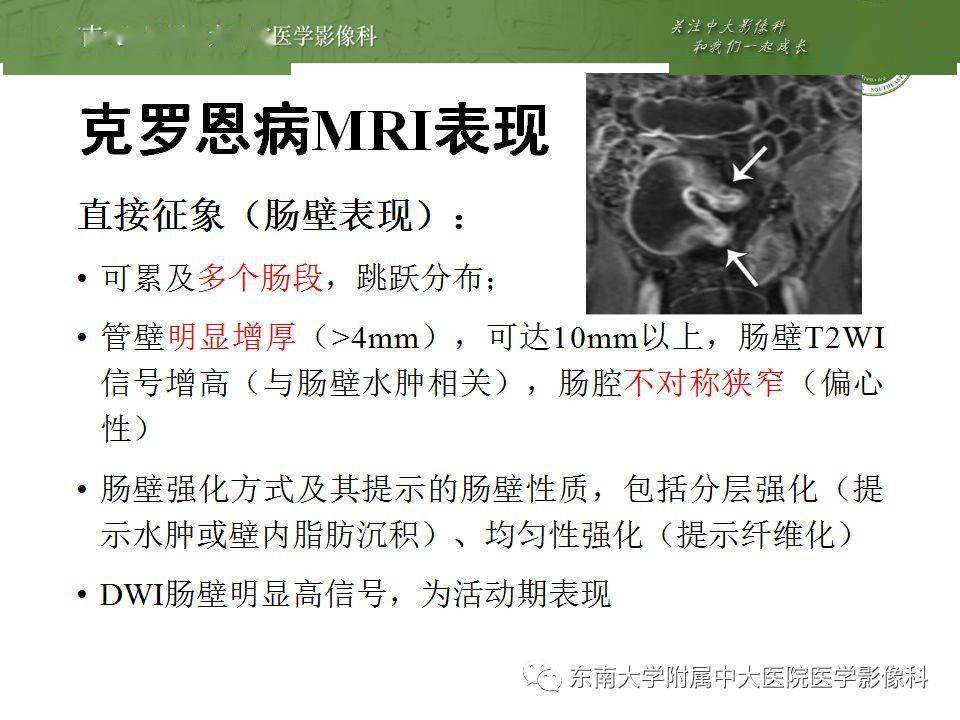 罗恩病是什么病_克罗恩病有什么症状_克罗恩病内镜图片