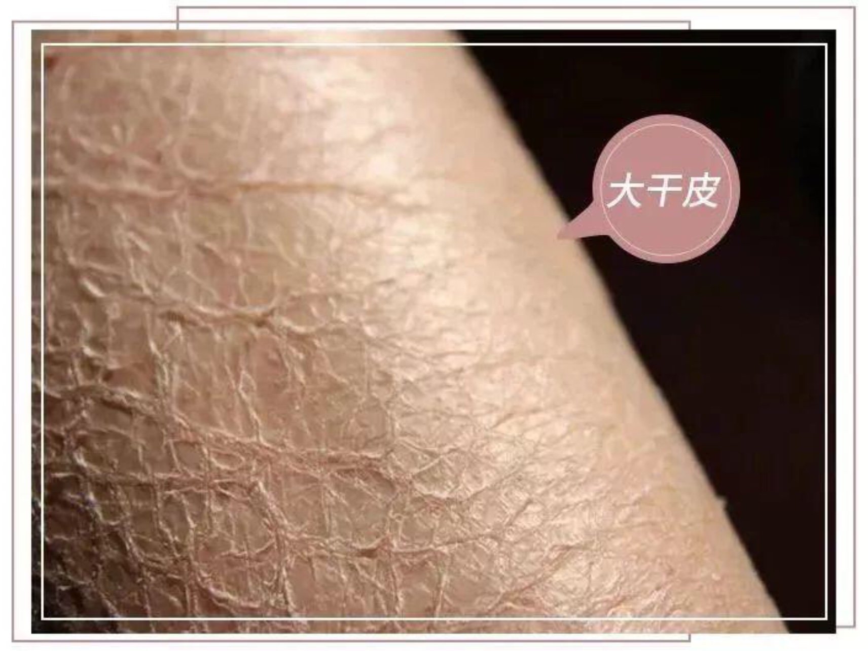 春天脸部蜕皮_春天脸脱皮是什么原因引起的_春天脸脱皮是什么原因
