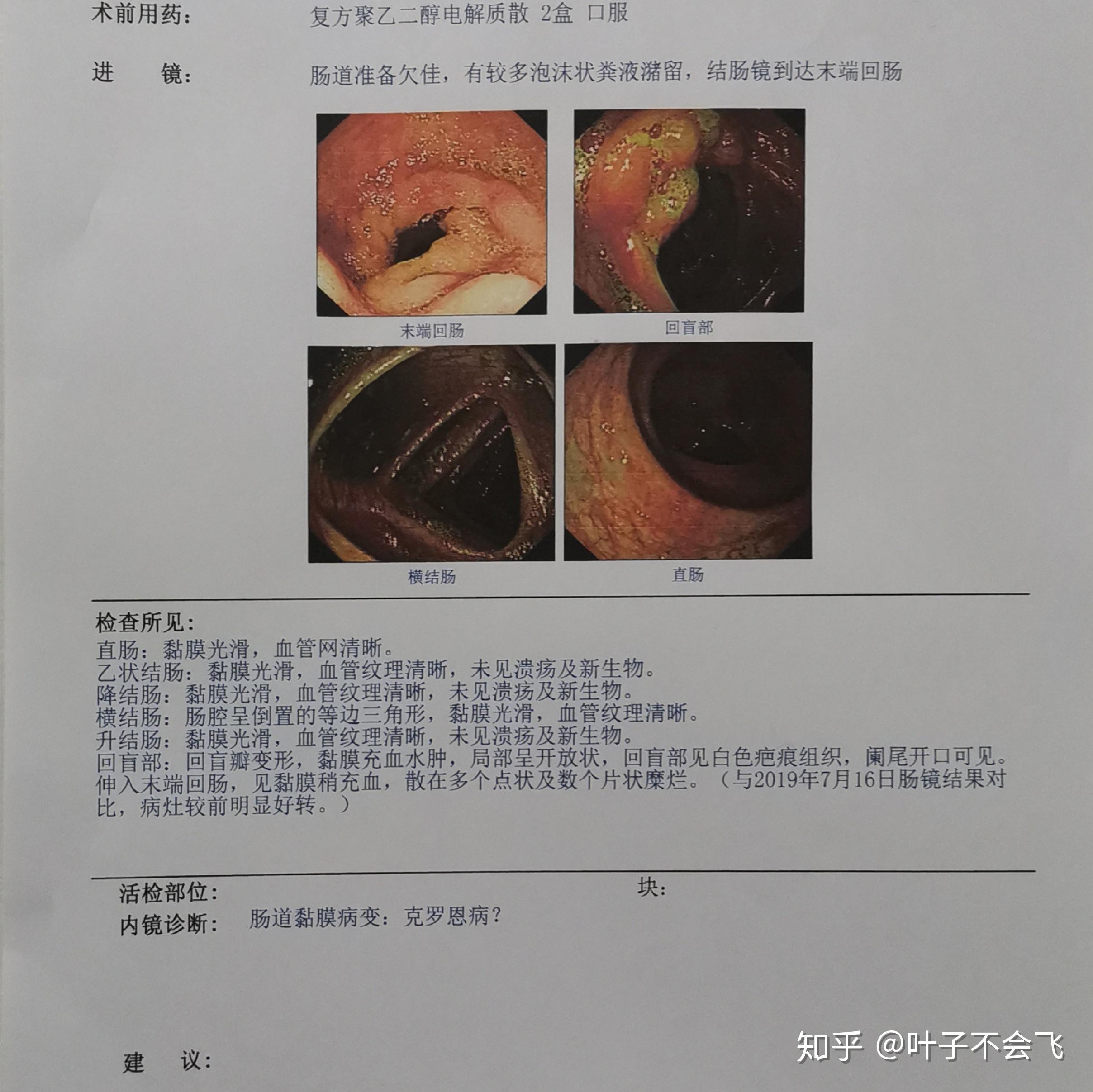 罗克罗恩病_克罗恩病(cd)_罗恩科病