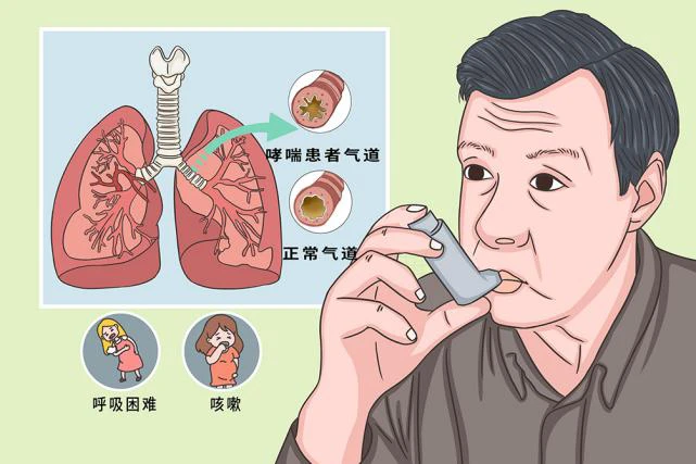 长寿病人哮喘有哪些症状_有长寿的哮喘病人吗_长寿病人哮喘有后遗症吗
