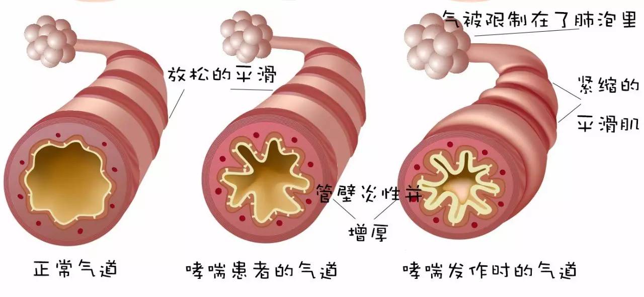 有长寿的哮喘病人吗_长寿病人哮喘有后遗症吗_长寿病人哮喘有哪些症状