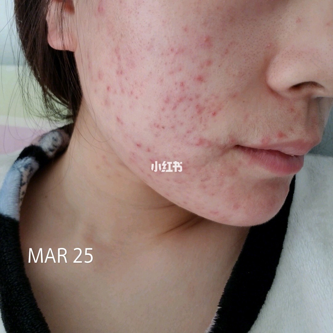 青春痘治理_青春痘治愈_青春痘为什么久治不愈