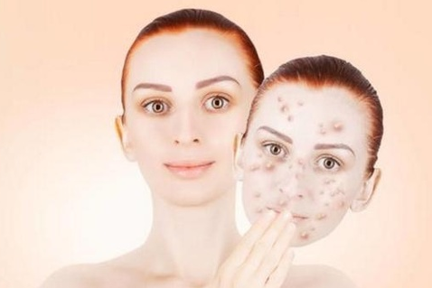 青春痘治理_青春痘治愈_青春痘为什么久治不愈