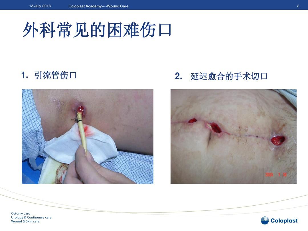 急性阑尾炎术后护理要点是什么_急性炎护理手术阑尾后多久恢复_急性阑尾炎手术后的护理