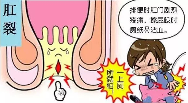 肛门失禁最常见的并发症_肛门失禁的症状 治疗_肛门症状治疗失禁多久能好
