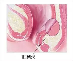 肛门症状治疗失禁多久能好_肛门失禁的症状 治疗_肛门失禁最常见的并发症