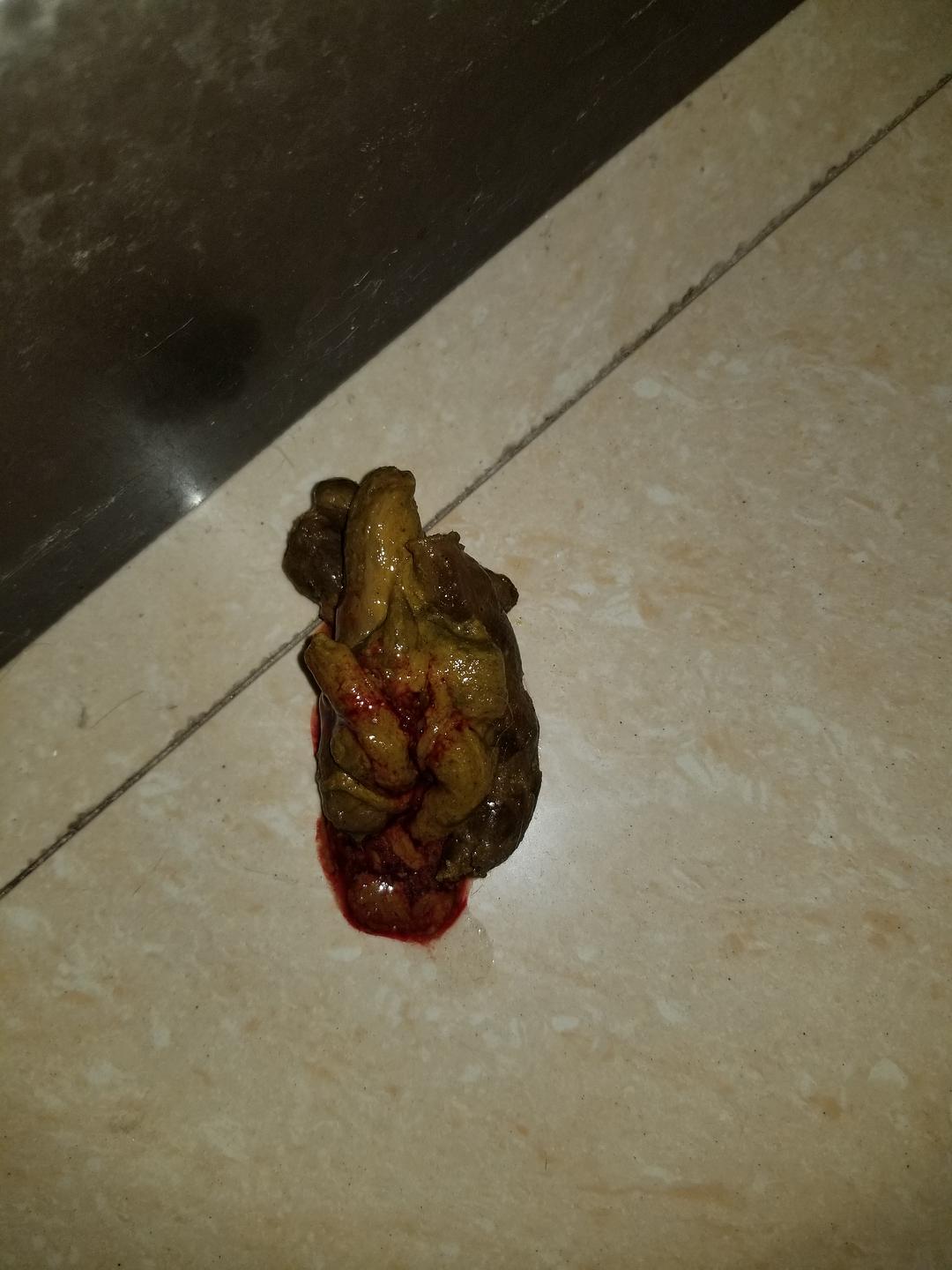 大便出鲜血严重吗_大便出鲜血能自愈吗_大便鲜血出血量大