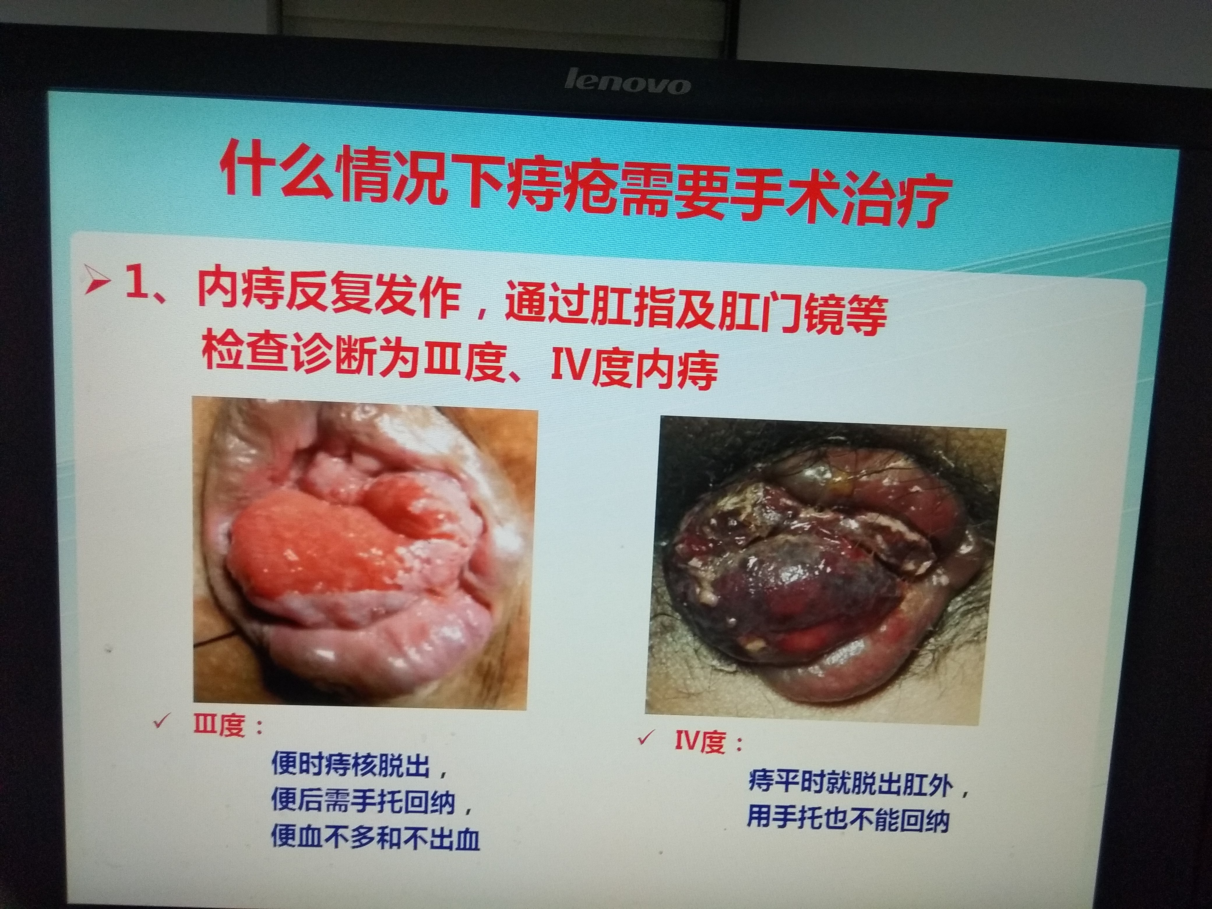 痔疮手术哪种手术最好图片