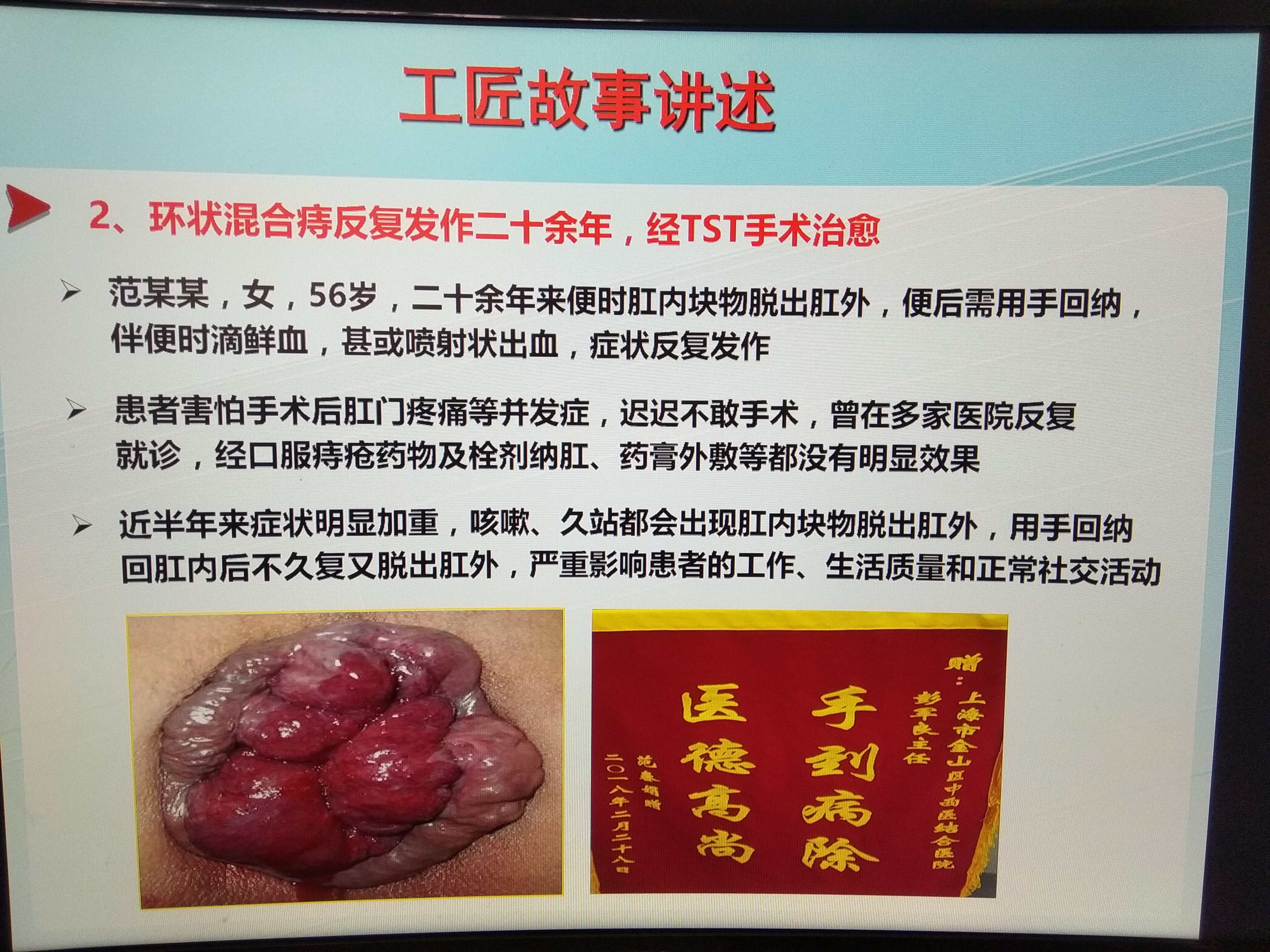 痔疮 肛瘘手术时间_手术痔疮肛瘘时间多长_手术痔疮肛瘘时间长吗