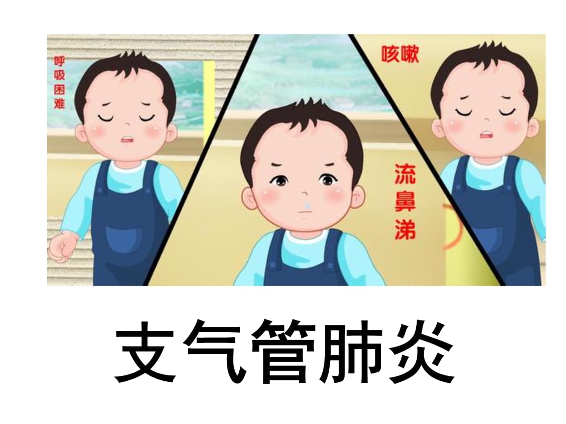 儿童支气管肺炎如何治疗_气管肺炎支治疗儿童首选药物_支气管肺炎小儿治疗