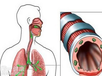 支气管肺炎小儿治疗_气管肺炎支治疗儿童首选药物_儿童支气管肺炎如何治疗
