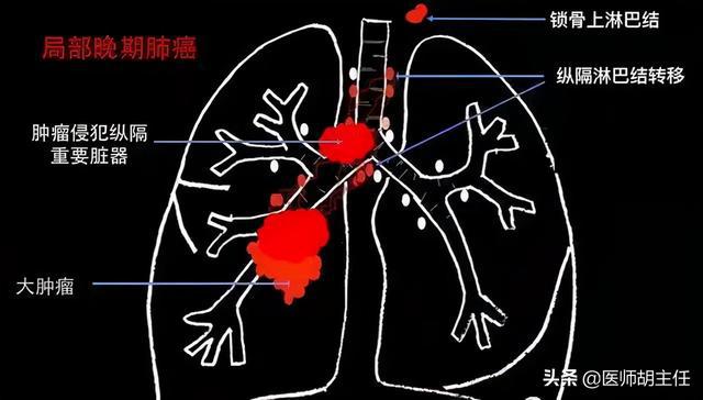 肺结核自愈型会遗传吗_肺结核自愈会留下痕迹吗_三型肺结核会自愈吗