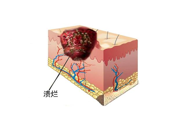 急性化脓性阑尾炎术后护理_急性化脓性阑尾炎术后护理_急性化脓性阑尾炎术后护理