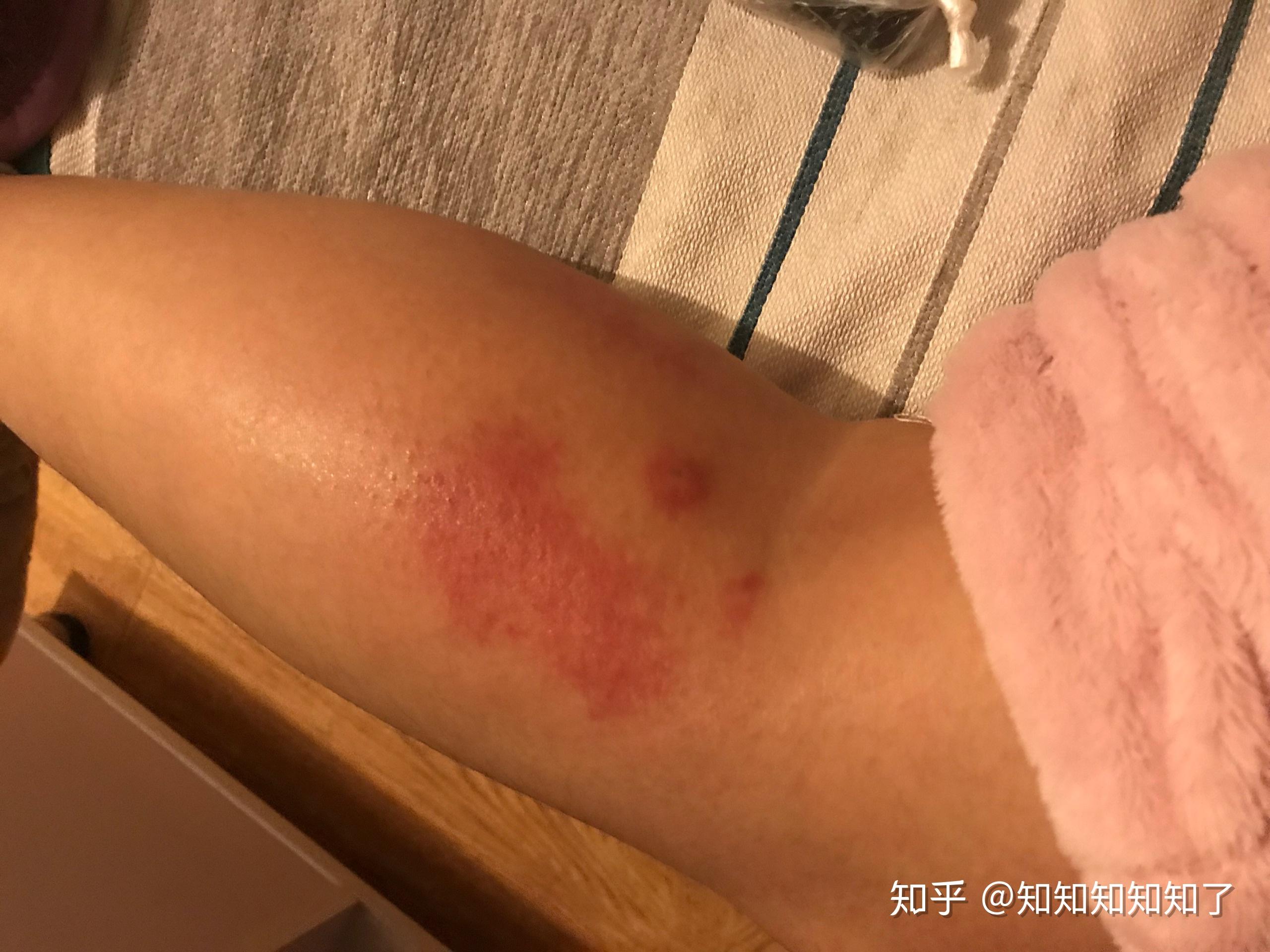 感冒后咳嗦痰多_感冒后痰多咳嗽怎么办_感冒后咳嗽痰多吃什么药好