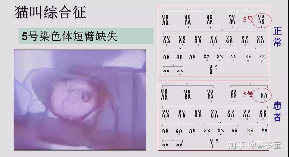 儿童间质性肺炎吃什么药_小儿间质性肺炎治疗_儿童间质性肺炎治疗
