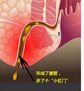 肛门失禁的症状及治疗_肛门感觉性失禁_肛门失禁能自愈吗
