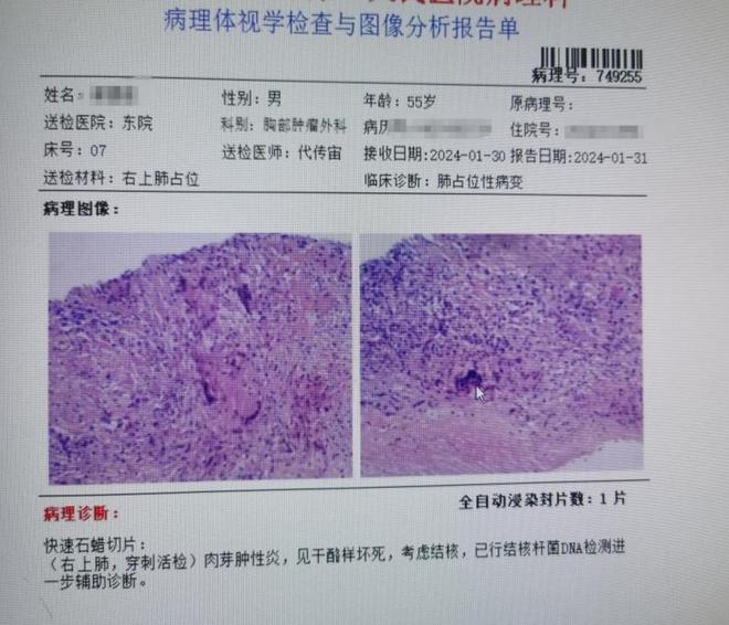 继发性肺结核多久能好_继发性肺结核会自愈_肺结核继发性严重吗