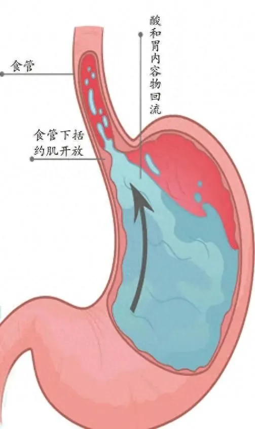 胃阴不足型慢性胃炎_胃阴虚慢性胃炎_慢性胃炎胃阴不足