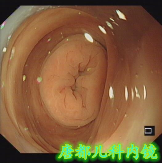 肠套叠ct描述模板_肠套叠ct图_肠套叠的典型ct征象