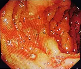 罗克恩病怎么确诊_克罗恩病 ct_罗克恩病早期症状