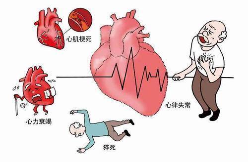 护理病人冠心病要点是什么_冠心病病人的护理要点_护理冠心病患者的注意事项