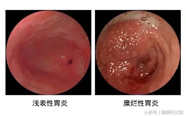 胃病久治不愈到底是什么原因_胃病久治不愈的原因_胃病久治不愈