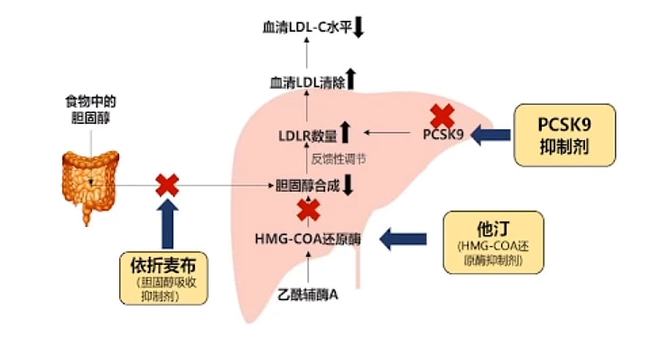 冠心病治疗药物与辅助方法：管理心血管疾病的关键措施