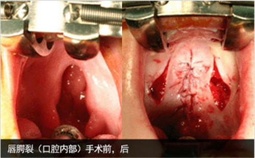 唇裂术后哭闹会伤口裂开吗_唇裂术后感冒咳嗽怎么办_咳嗽嘴唇干裂吃什么药