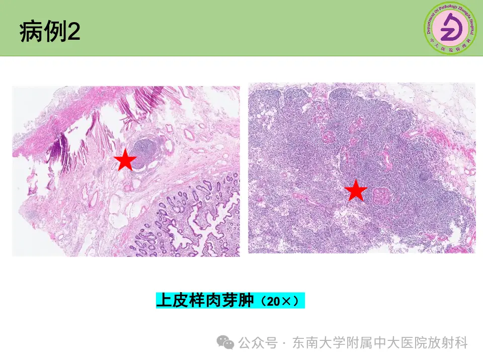 克罗恩病类克停了用什么药维持_克罗恩类克控制住了能不打吗_克罗恩类克能停药