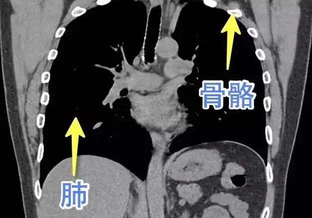 肺ct 白-深度探析肺部CT白影：特征、疾病表现与诊断重要性