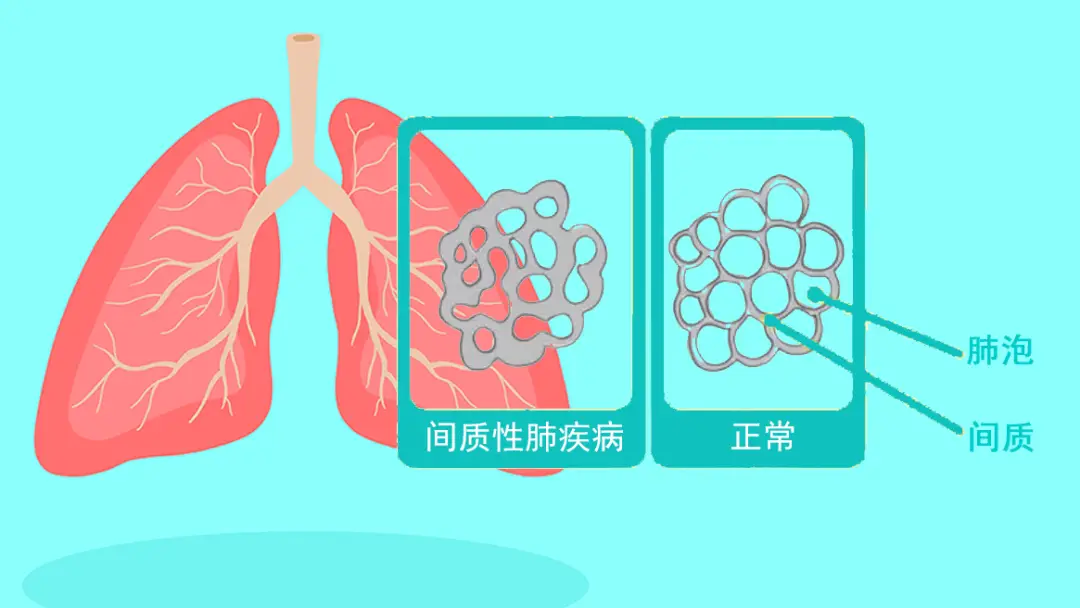 体检肺细胞角蛋白偏高_肺细胞角蛋白高虚惊一场_肺细胞角蛋白