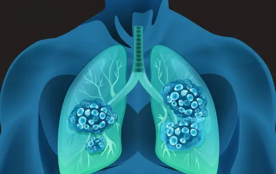 肺细胞角蛋白_肺细胞角蛋白高虚惊一场_体检肺细胞角蛋白偏高