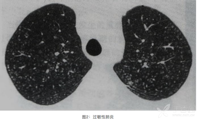 肺部感染的证状_肺部感染的症状_感染症状肺部ct表现