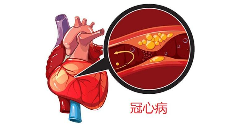 冠心病护理个案-冠心病护理之旅：温暖陪伴与心灵支持的责任使命