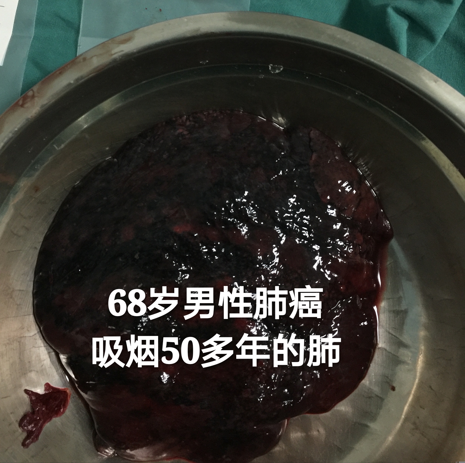 肺蛋白质沉积_肺蛋白沉积症是癌症吗_肺蛋白沉积