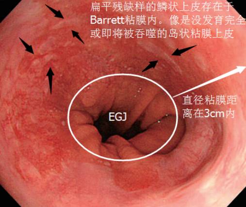 消化道穿孔ct图片-医学影像技师眼中的消化道穿孔：背后的生命故事