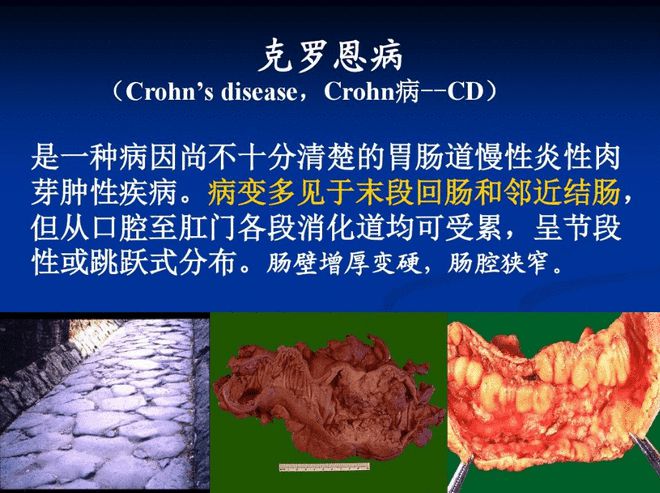 克罗恩是什么病_罗克恩病是什么病_课罗恩病