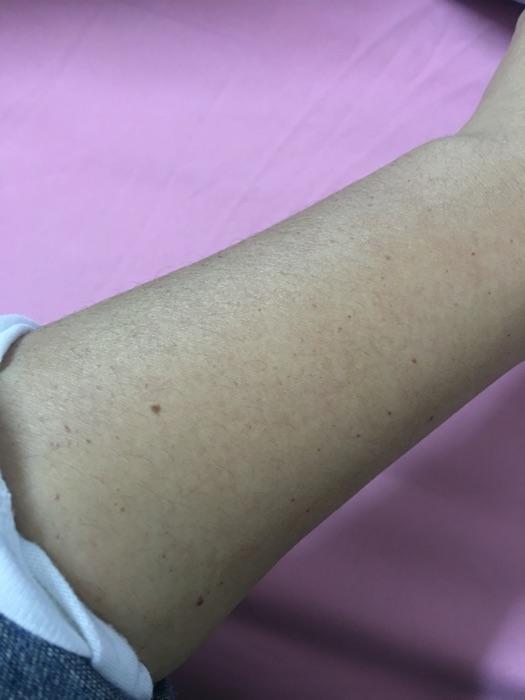 手臂上有很多小红点渗血_手臂出血小红点_手臂红点出血