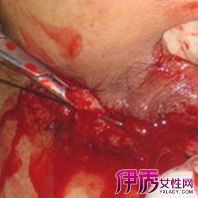 痔疮 肛瘘手术时间_痔疮手术肛瘘手术多久能好_手术痔疮肛瘘时间多久