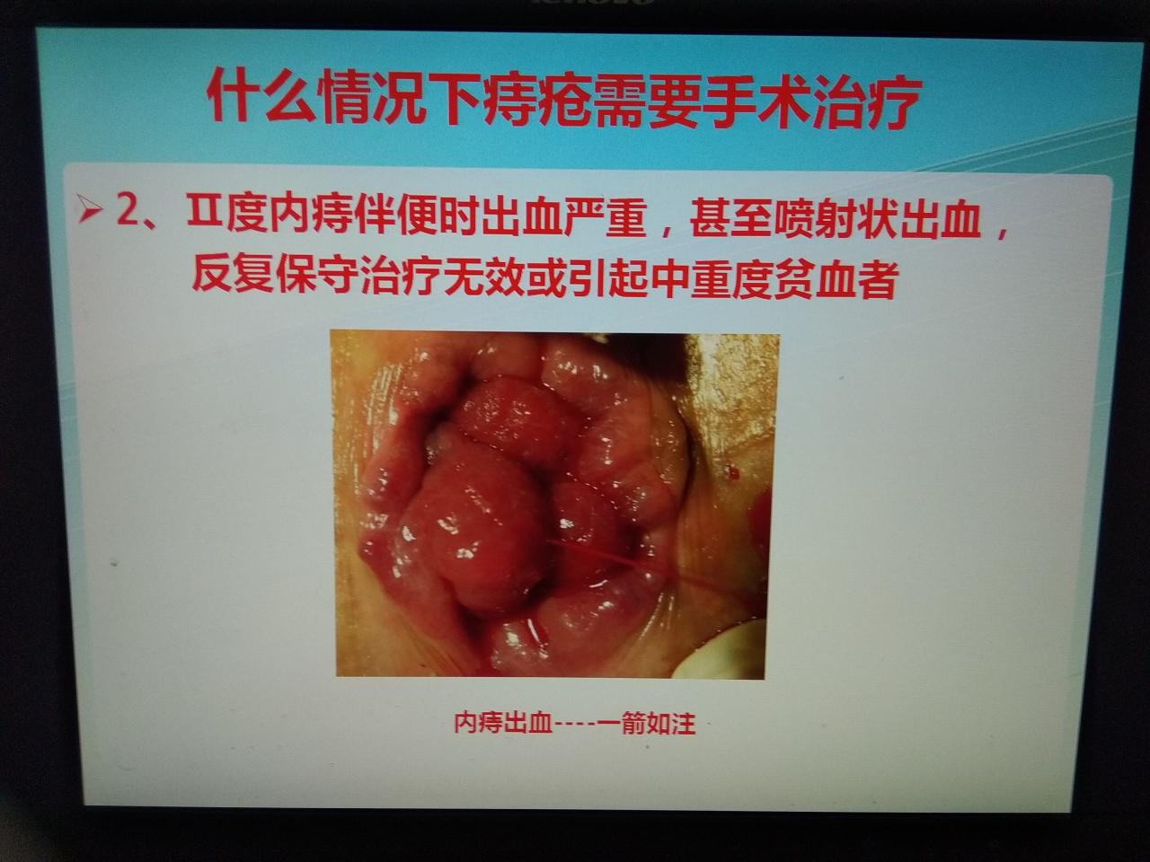 手术痔疮肛瘘时间多久_痔疮 肛瘘手术时间_痔疮手术肛瘘手术多久能好
