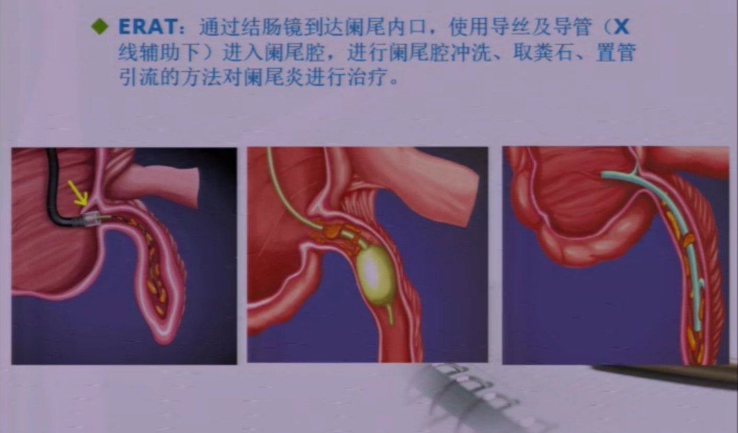 急性阑尾炎术后护理诊断_急性阑尾炎术后护理诊断_急性阑尾炎术后常见的护理诊断