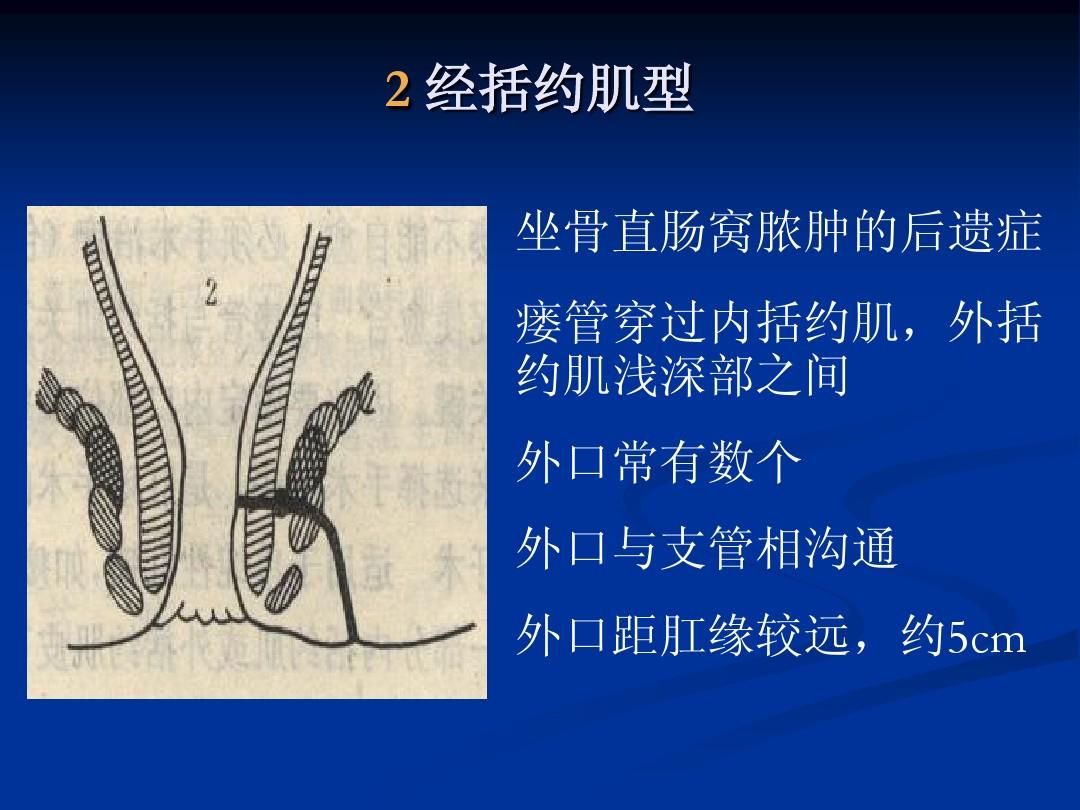 手术女性肛瘘时间多长_女人肛瘘手术_女性肛瘘手术时间