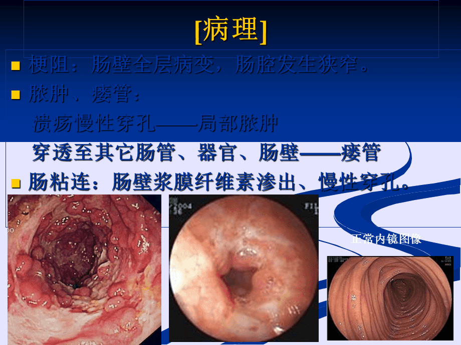 克罗恩病护理查房ppt_克罗恩病护理问题和护理诊断_克罗恩病护理查房ppt课件
