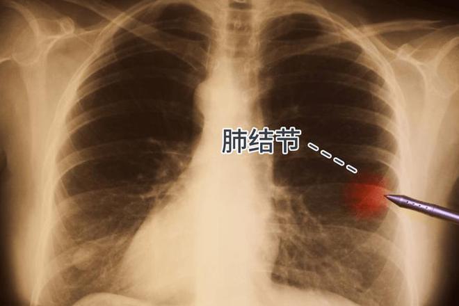 肺结核空洞闭合是什么意思_空洞型肺结核多久闭合_空洞型肺结核闭合了还传染吗