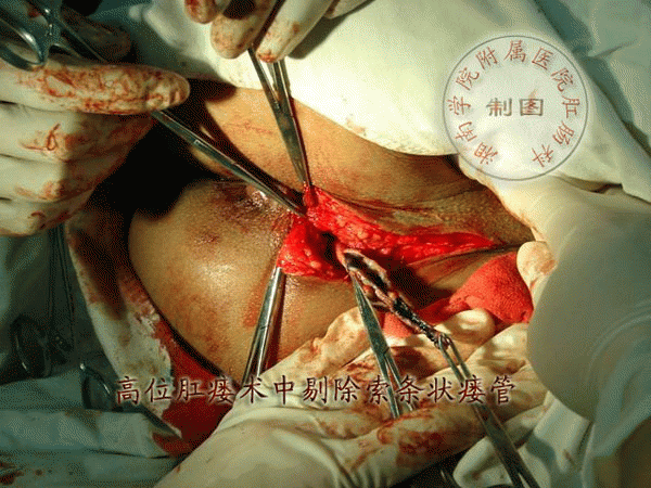 多长手术坐浴肛瘘时间后不疼_多长手术坐浴肛瘘时间后最好_肛瘘手术后多长时间坐浴