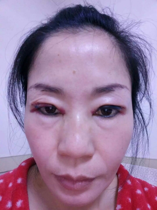 双眼皮拆线好天天换药吗_双眼皮几天拆线最好_双眼皮今天拆线