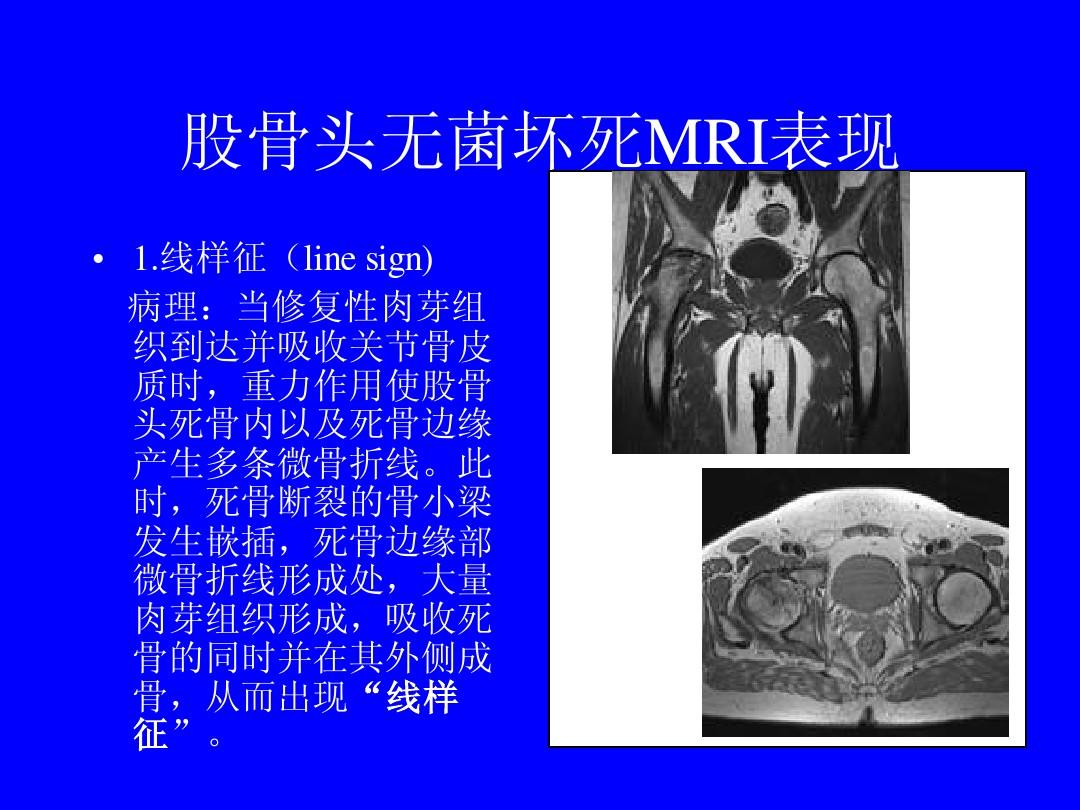 线样征,铅管征,跳跃征_克罗恩病线样征x图片_铅管征和线样征图片