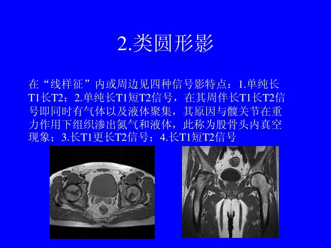 铅管征和线样征图片_克罗恩病线样征x图片_线样征,铅管征,跳跃征