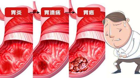 治愈胃病的药_治愈胃病的食物_胃病能治愈吗