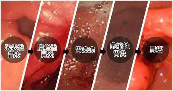 治愈胃病的食物_治愈胃病的药_胃病能治愈吗